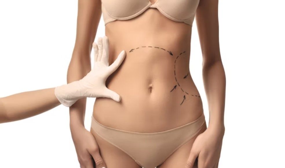 Revolutionising Body Contouring with Modern Liposuction