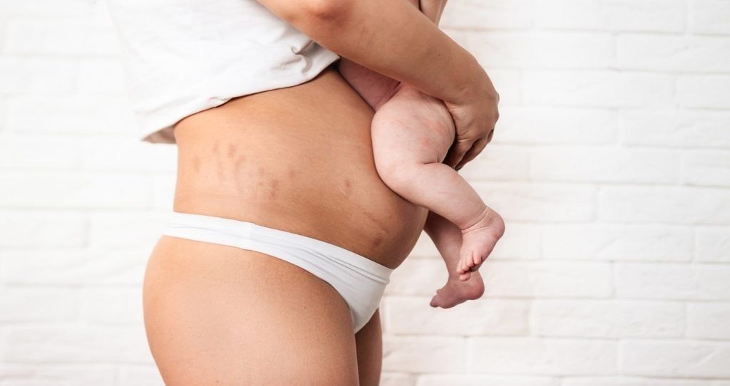 Lipo After C Section: A Comprehensive Guide for New Moms