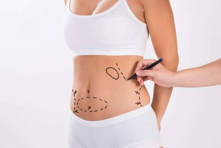 Understanding Elective Liposuction: A Comprehensive Guide