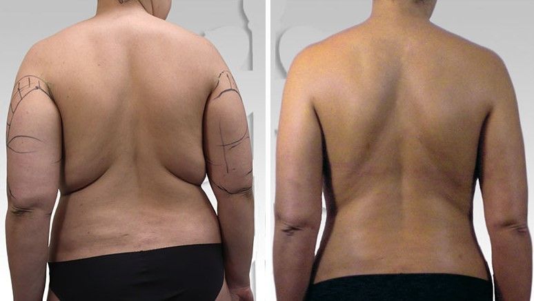 Comprehensive Guide to Liposuction on Arms and Back