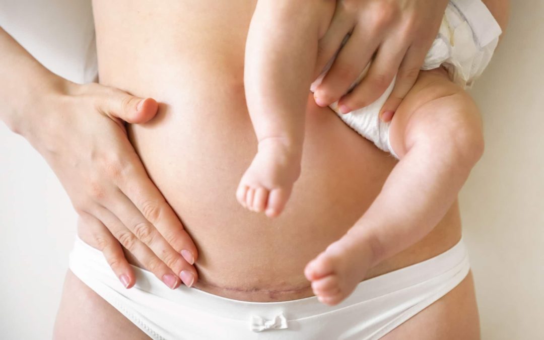 Transform Your Post-Baby Body: CoolSculpting Mommy Makeover