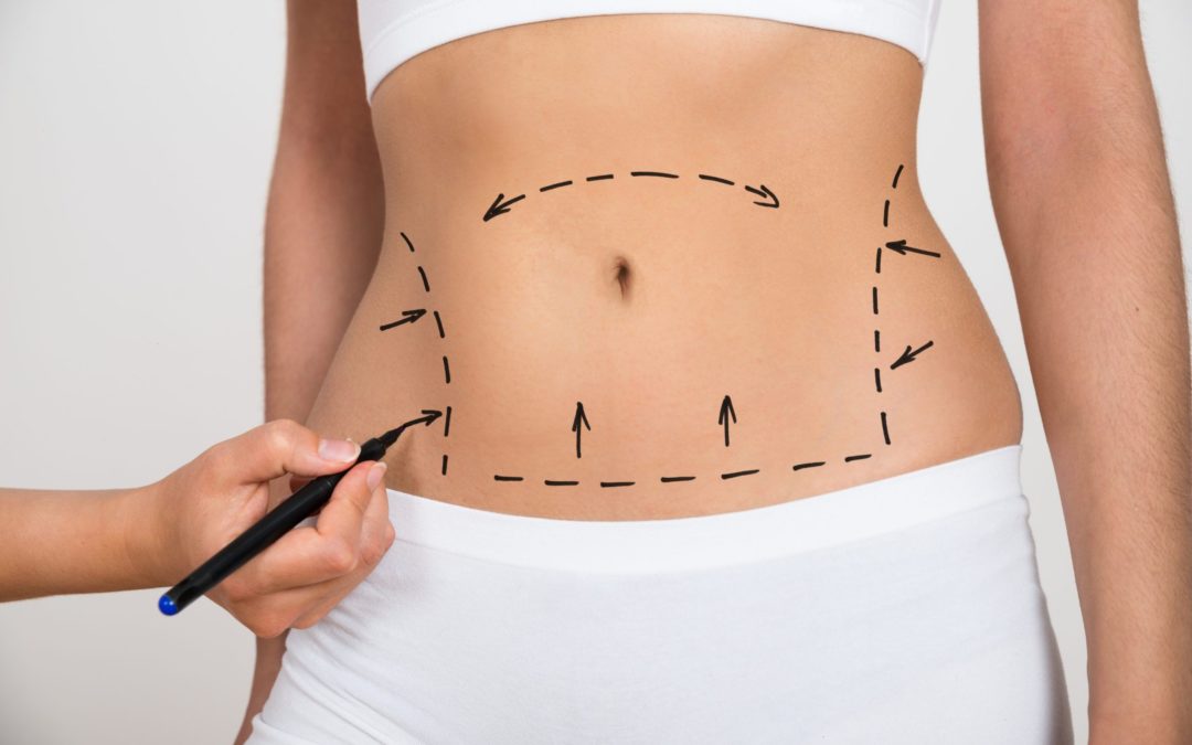 Understanding the Mommy Makeover Fat Transfer Process