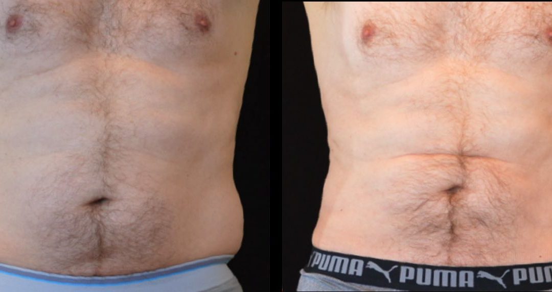 Understanding Trunk Liposuction: A Comprehensive Guide