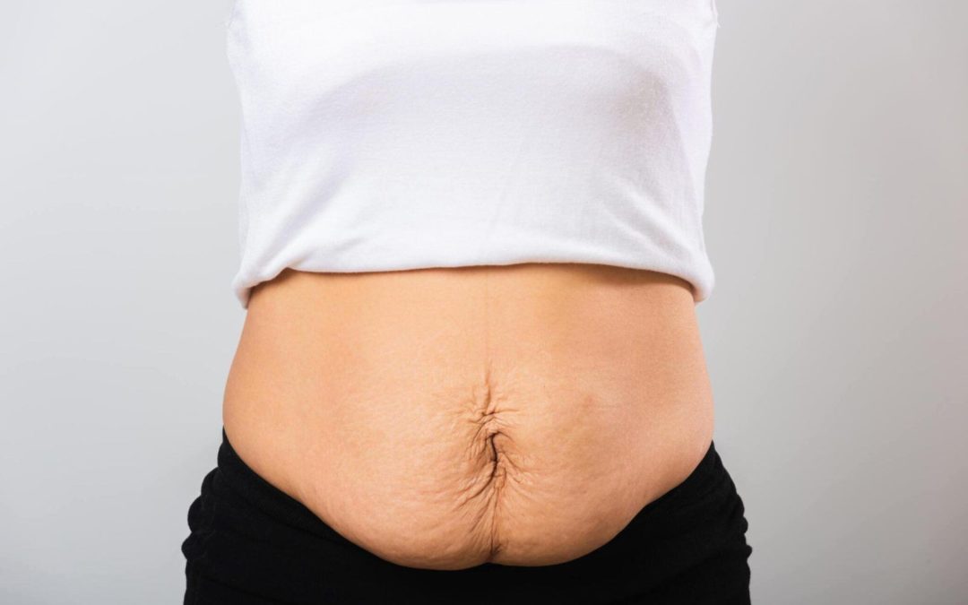 Understanding Mega Lipo: A Comprehensive Guide