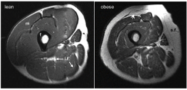 Fett an den Beinen MRI