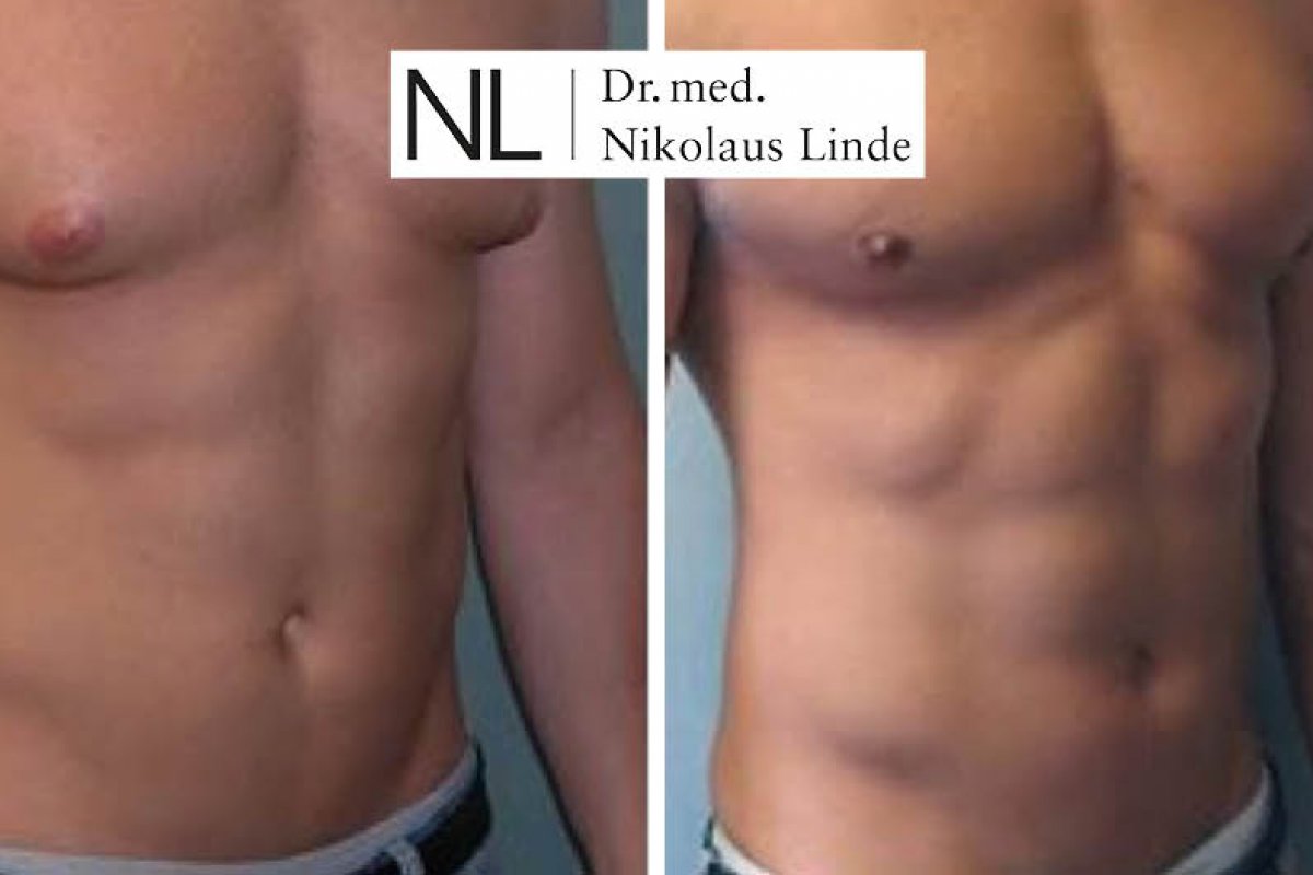 Liposculpture vorher/nachher