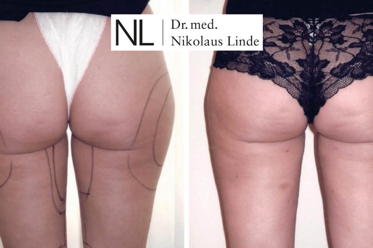 Liposuktion vorher/nachher